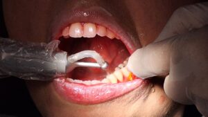 limpeza dentária dentista lago norte