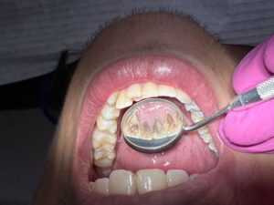 odontologia geral odontopediatra clareamento dental dentista canal alinhadores invisíveis sousmile botox lente de contato dental tratamento de canal prótese dentária implantes implantes dentário implante dentário ortodontia clínica odontológica consultorio odontológico odontologia clínica de implante dentário endodontia limpeza dos dentes cirurgião dentista extração do siso retirada do siso cirurgia do siso aparelho ortodontico odontopediatra em brasília odontopediatra distrito federal odontopediatra df odontopediatra lago norte clareamento dental clareamento dental em brasília clareamento dental lago norte clareamento dental df clareamento dentral distrito federal clareamento dos dentes dentista clareamento dentista em brasília dentista lago norte dentista distrito federal dentista df cliníca de tratamento de canal em brasília cliníca de tratamento de canal lago norte cliníca de tratamento de canal df cliníca de tratamento de canal distrito federal cliníca de prótese dentária em brasília cliníca de prótese dentária lago norte cliníca de prótese dentária df cliníca de prótese dentária distrito federal implantes dentário em brasília implantes dentário lago norte implantes dentário df implantes dentário distrito federal clínica de implante dentário em brasília clínica de implante dentário df clínica de implante dentário distrito federal clínica odontológica em brasília clínica odontológica lago norte clínica odontológica df clínica odontológica distrito federal cirurgião dentista brasília cirurgião dentista lago norte cirurgião dentista df cirurgião dentista distrito federal endodontia lago norte endodontia brasília endodontia df endodontia distrito federal ortodontia brasília ortodontia lago norte ortodontia distrito federal ortodontia df prótese dentária brasília prótese dentária lago norte prótese dentária df prótese dentária distrito federal aparelho ortodontico brasília aparelho ortodontico lago norte aparelho ortodontico df aparelho ortodontico di