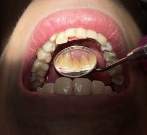 odontologia geral odontopediatra clareamento dental dentista canal alinhadores invisíveis sousmile botox lente de contato dental tratamento de canal prótese dentária implantes implantes dentário implante dentário ortodontia clínica odontológica consultorio odontológico odontologia clínica de implante dentário endodontia limpeza dos dentes cirurgião dentista extração do siso retirada do siso cirurgia do siso aparelho ortodontico odontopediatra em brasília odontopediatra distrito federal odontopediatra df odontopediatra lago norte clareamento dental clareamento dental em brasília clareamento dental lago norte clareamento dental df clareamento dentral distrito federal clareamento dos dentes dentista clareamento dentista em brasília dentista lago norte dentista distrito federal dentista df cliníca de tratamento de canal em brasília cliníca de tratamento de canal lago norte cliníca de tratamento de canal df cliníca de tratamento de canal distrito federal cliníca de prótese dentária em brasília cliníca de prótese dentária lago norte cliníca de prótese dentária df cliníca de prótese dentária distrito federal implantes dentário em brasília implantes dentário lago norte implantes dentário df implantes dentário distrito federal clínica de implante dentário em brasília clínica de implante dentário df clínica de implante dentário distrito federal clínica odontológica em brasília clínica odontológica lago norte clínica odontológica df clínica odontológica distrito federal cirurgião dentista brasília cirurgião dentista lago norte cirurgião dentista df cirurgião dentista distrito federal endodontia lago norte endodontia brasília endodontia df endodontia distrito federal ortodontia brasília ortodontia lago norte ortodontia distrito federal ortodontia df prótese dentária brasília prótese dentária lago norte prótese dentária df prótese dentária distrito federal aparelho ortodontico brasília aparelho ortodontico lago norte aparelho ortodontico df aparelho ortodontico di