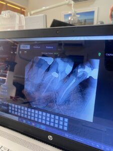 tratamento de canal df tratamento de canal brasilia tratamento de canal lago norte endodontia brasilia 