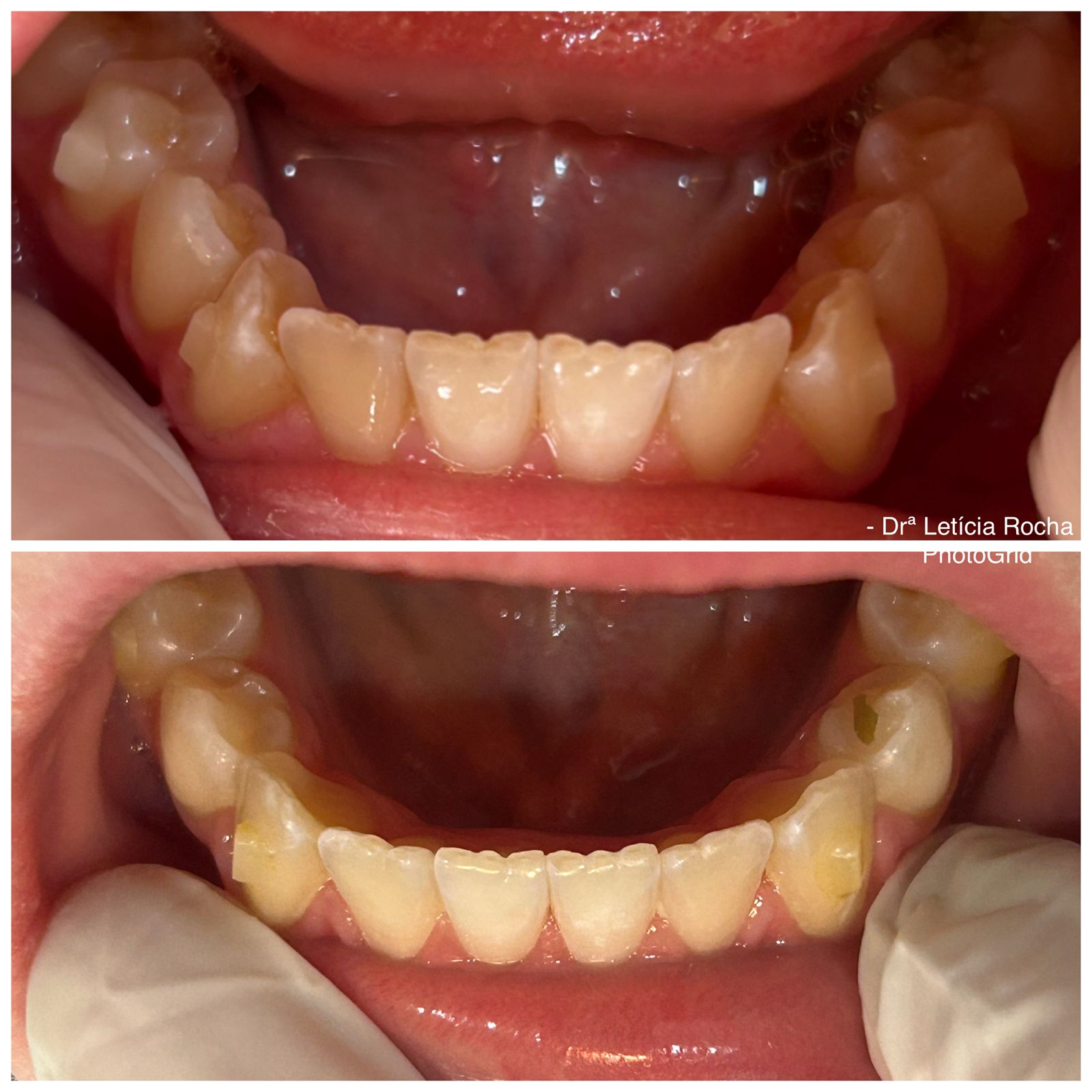 Vista oclusal superior