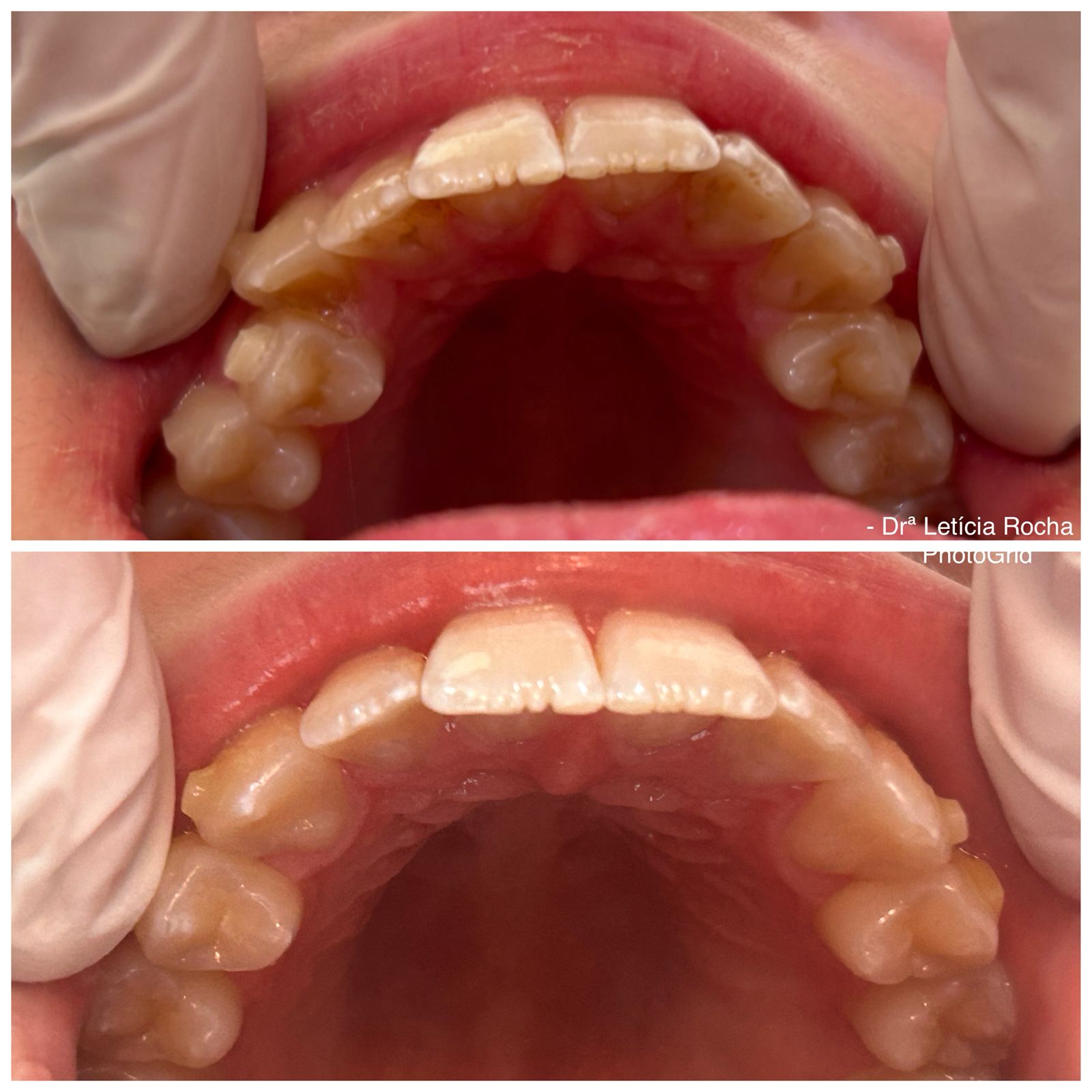 Vista oclusal superior