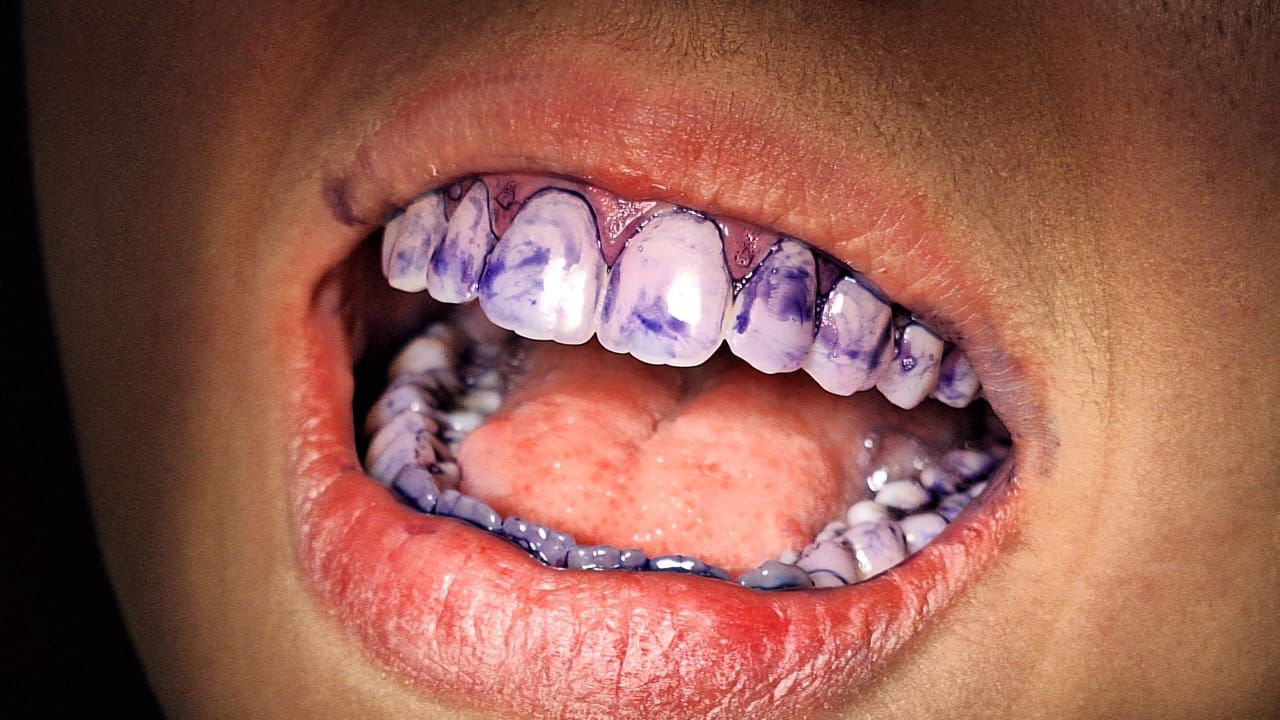 limpeza dentária dentista lago norte