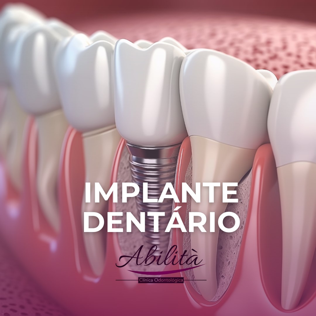 implante dentário brasília implante dentário df implantes dentários