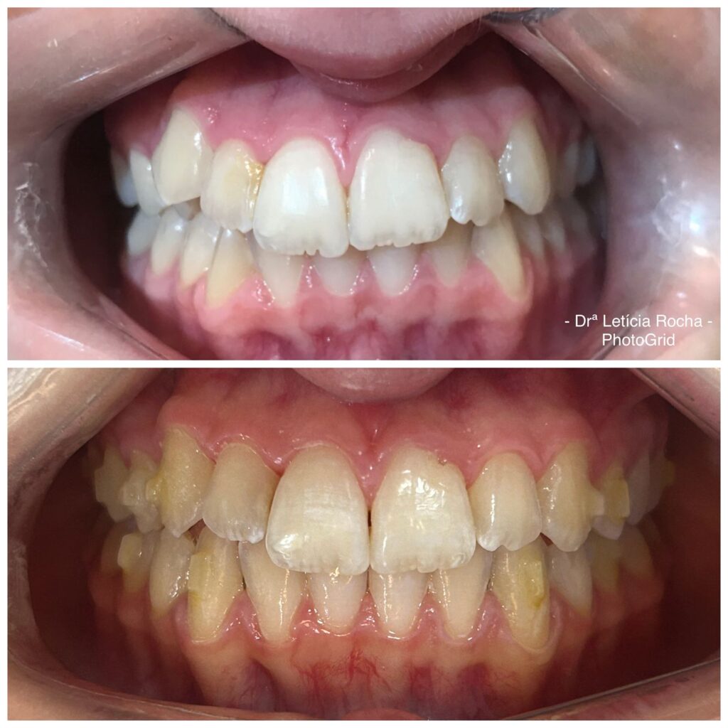 aparelho invisivel brasilia alinhador invisivel brasilia invisalign brasilia sousmile brasilia