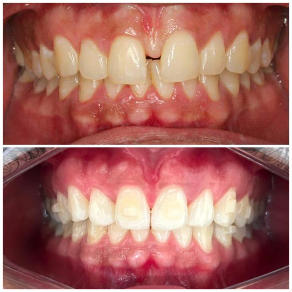 aparelho invisivel brasilia; alinhador invisivel brasilia; invisalign brasilia lp