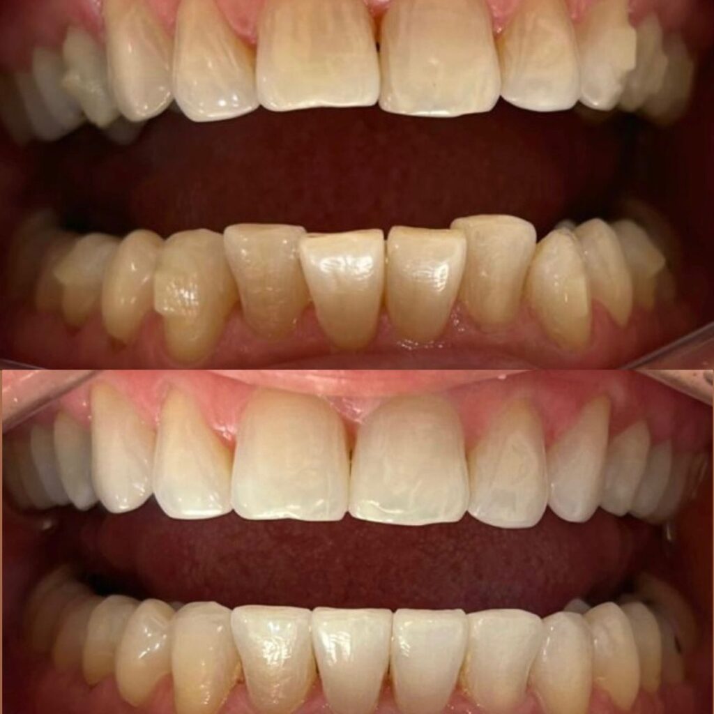 aparelho invisivel brasilia; alinhador invisivel brasilia; invisalign brasilia lp1