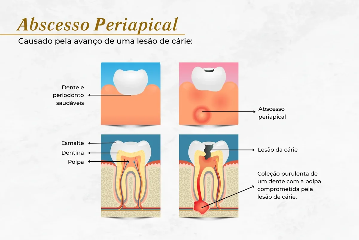 Abscesso periapical causado por cárie avançada, sinal de que o canal é necessário — Abilità, Brasília