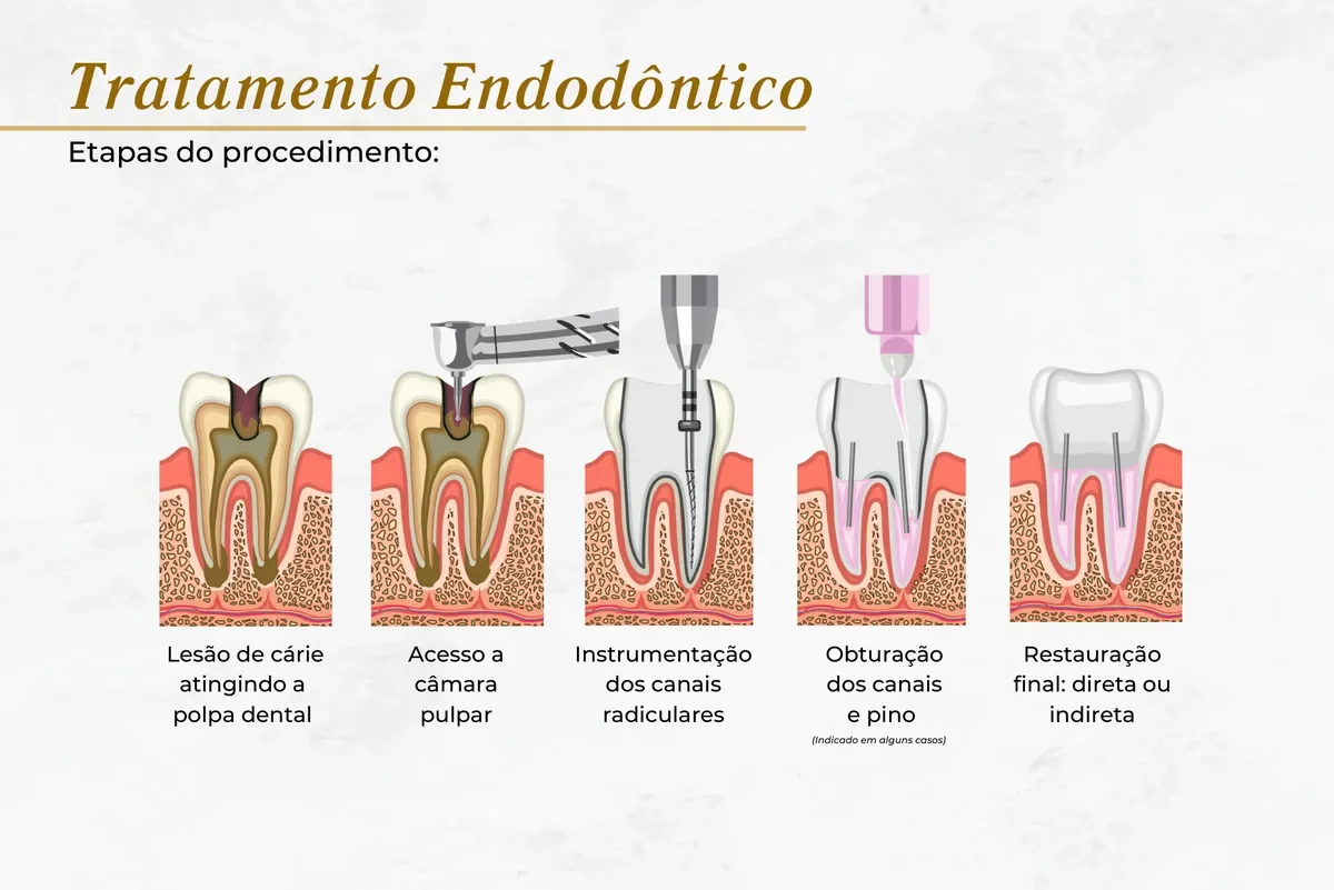 Tratamento de canal feito por endodontista — Abilità, Lago Norte, Brasília