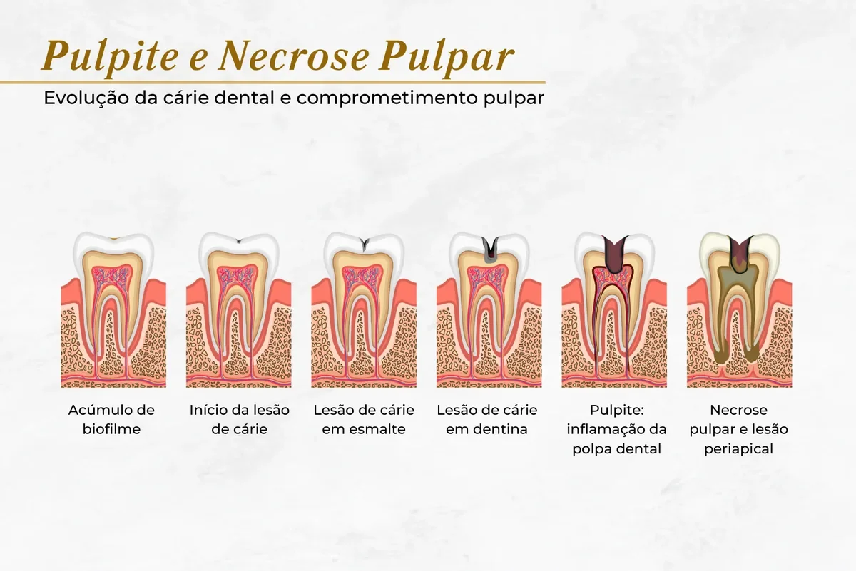 Da cárie à necrose pulpar: quando o canal é indicado — Abilità, Lago Norte, Brasília