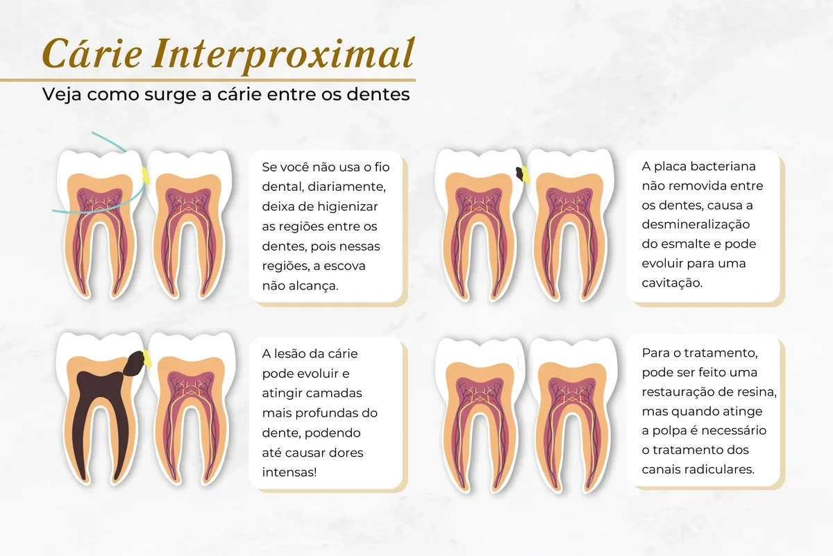 Cárie entre os dentes detectada em check-up — Abilità, Lago Norte, Brasília