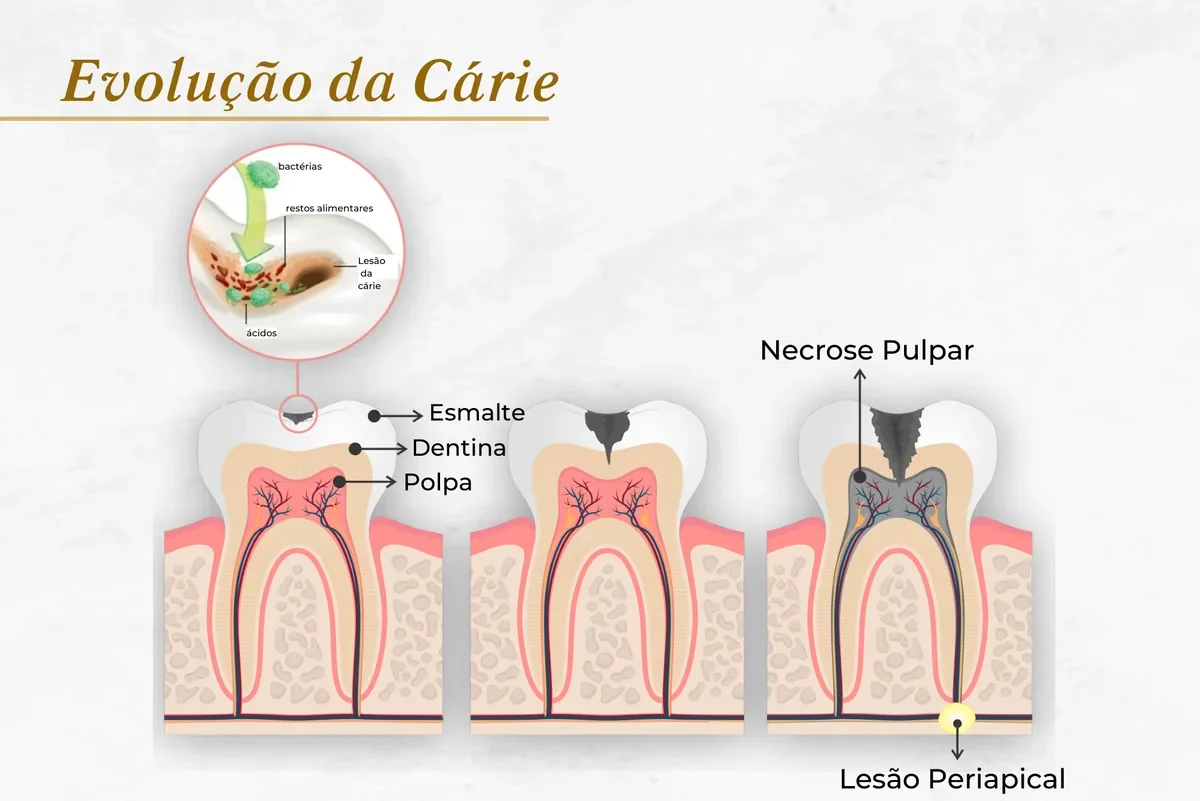Origem e evolução da cárie dental — Abilità, Lago Norte, Brasília