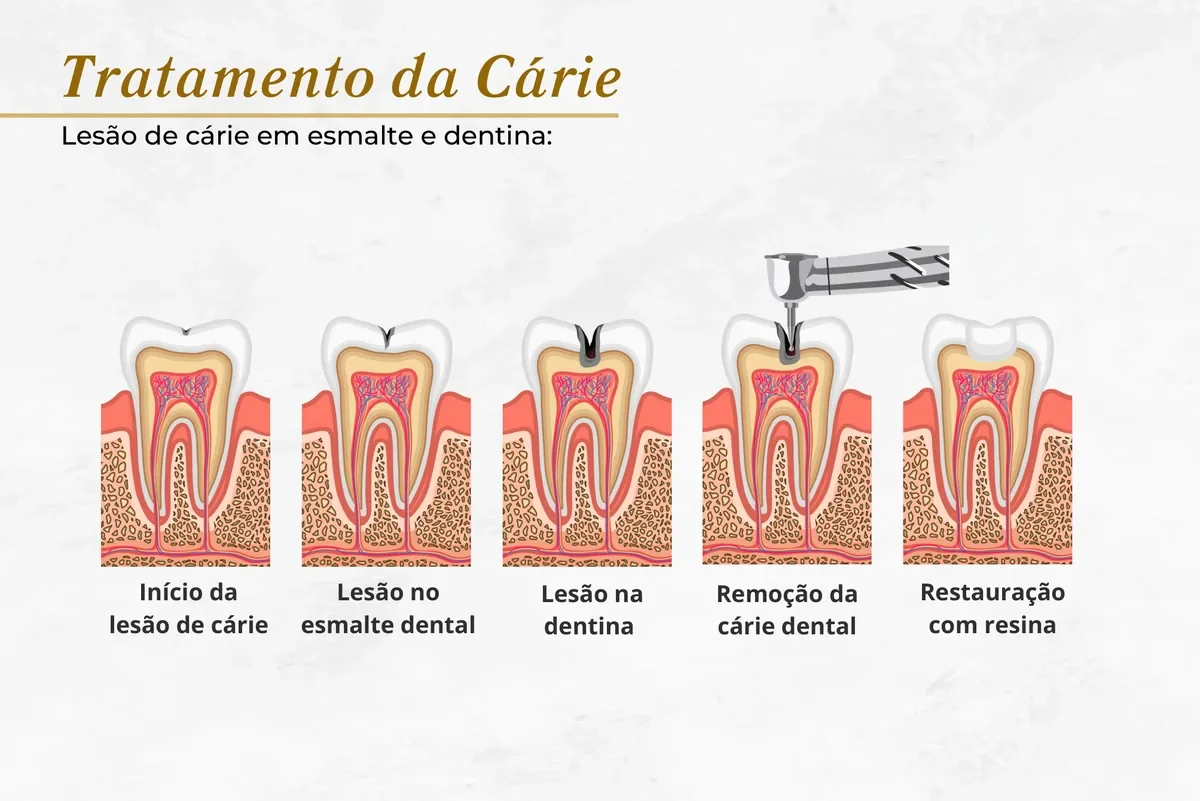 Tratamento da lesão de cárie — Abilità, Brasília