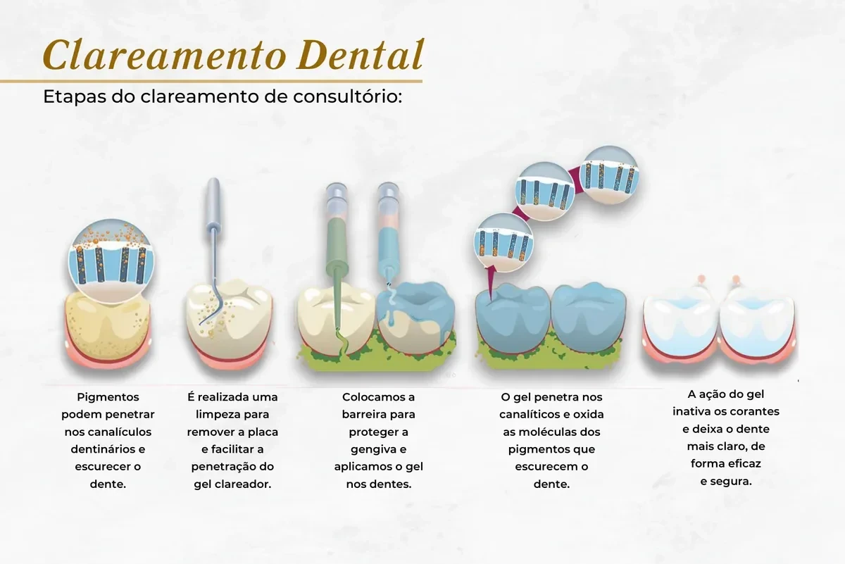 Clareamento dental de consultório — Abilità, Brasília