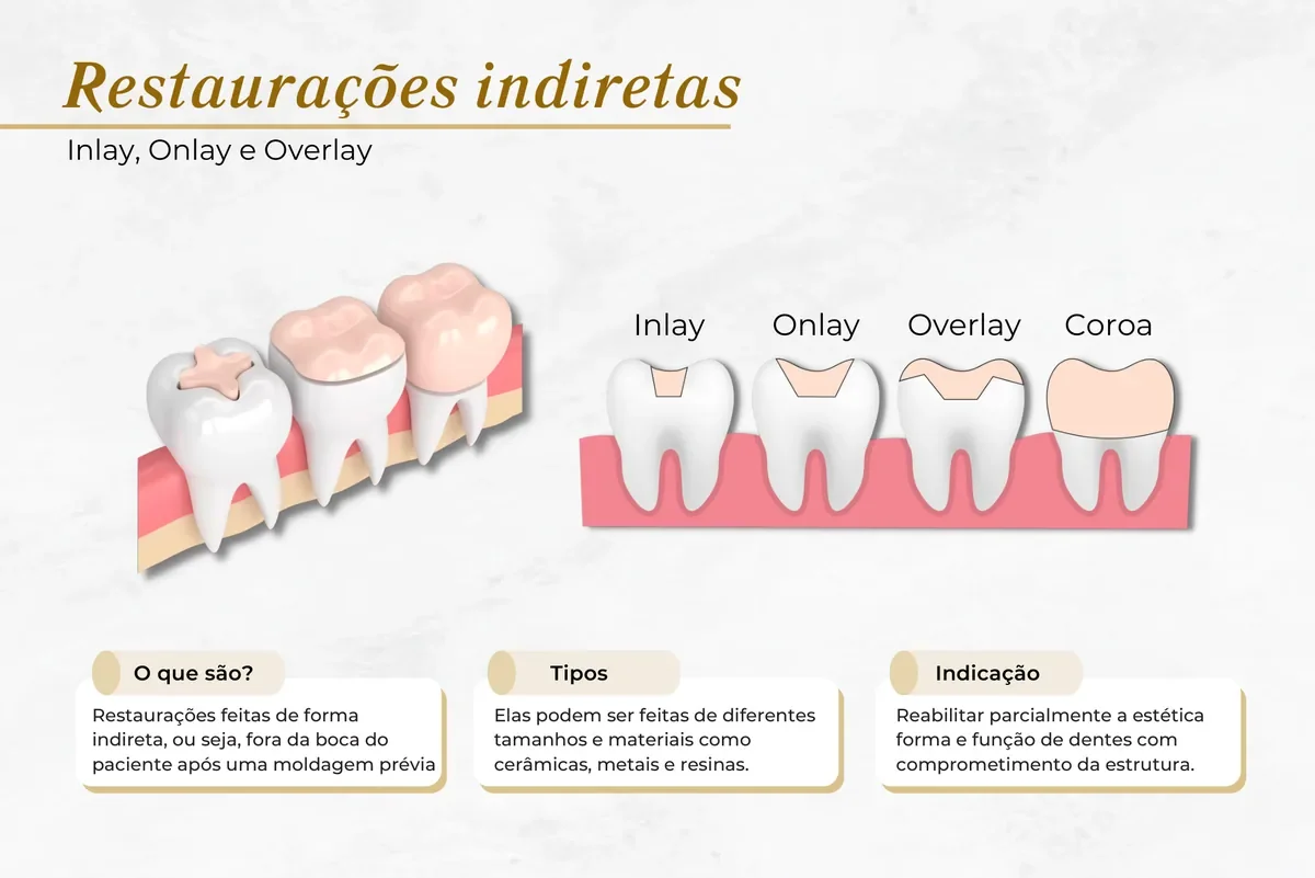 Bloco dentário: inlay, onlay e overlay — Abilità, Lago Norte, Brasília