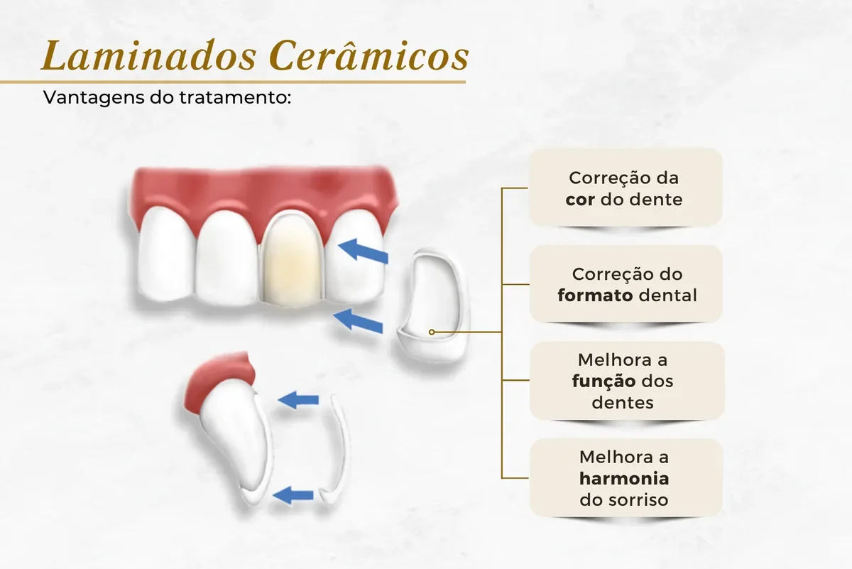 Facetas e lentes de contato dental em Brasília: como funciona o planejamento