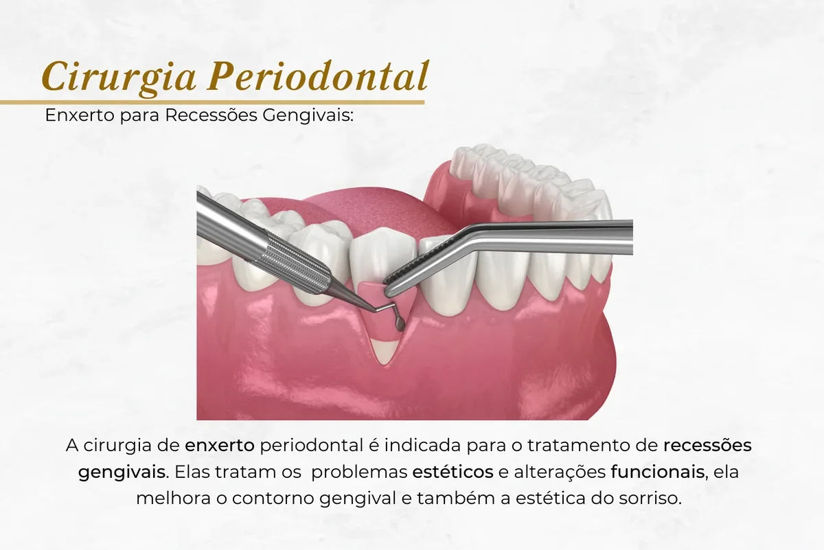 Enxerto gengival para recobrir a raiz — Abilità, Brasília