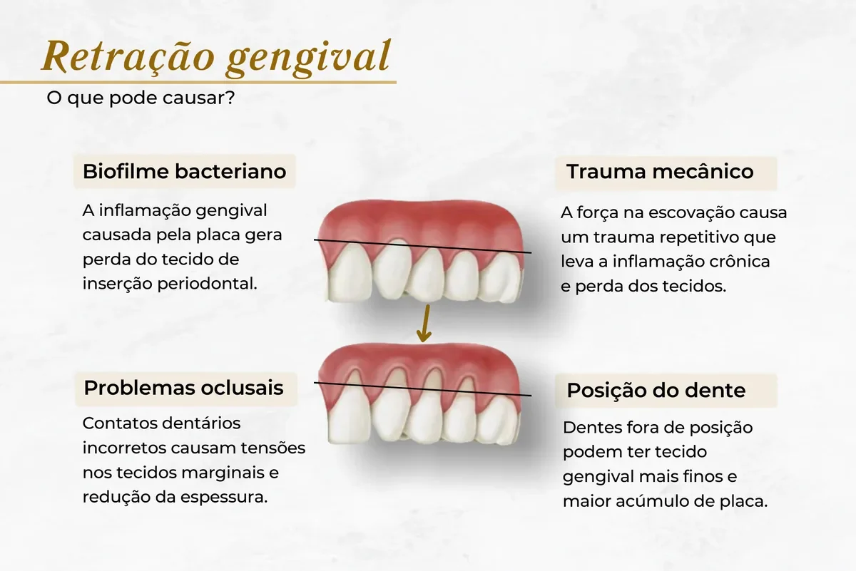 Retração gengival: causas, consequências e tratamento em Brasília