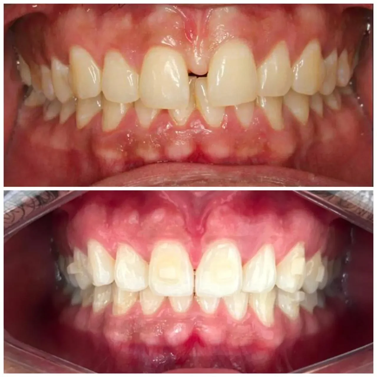 Antes e depois alinhadores &mdash; Gabriel