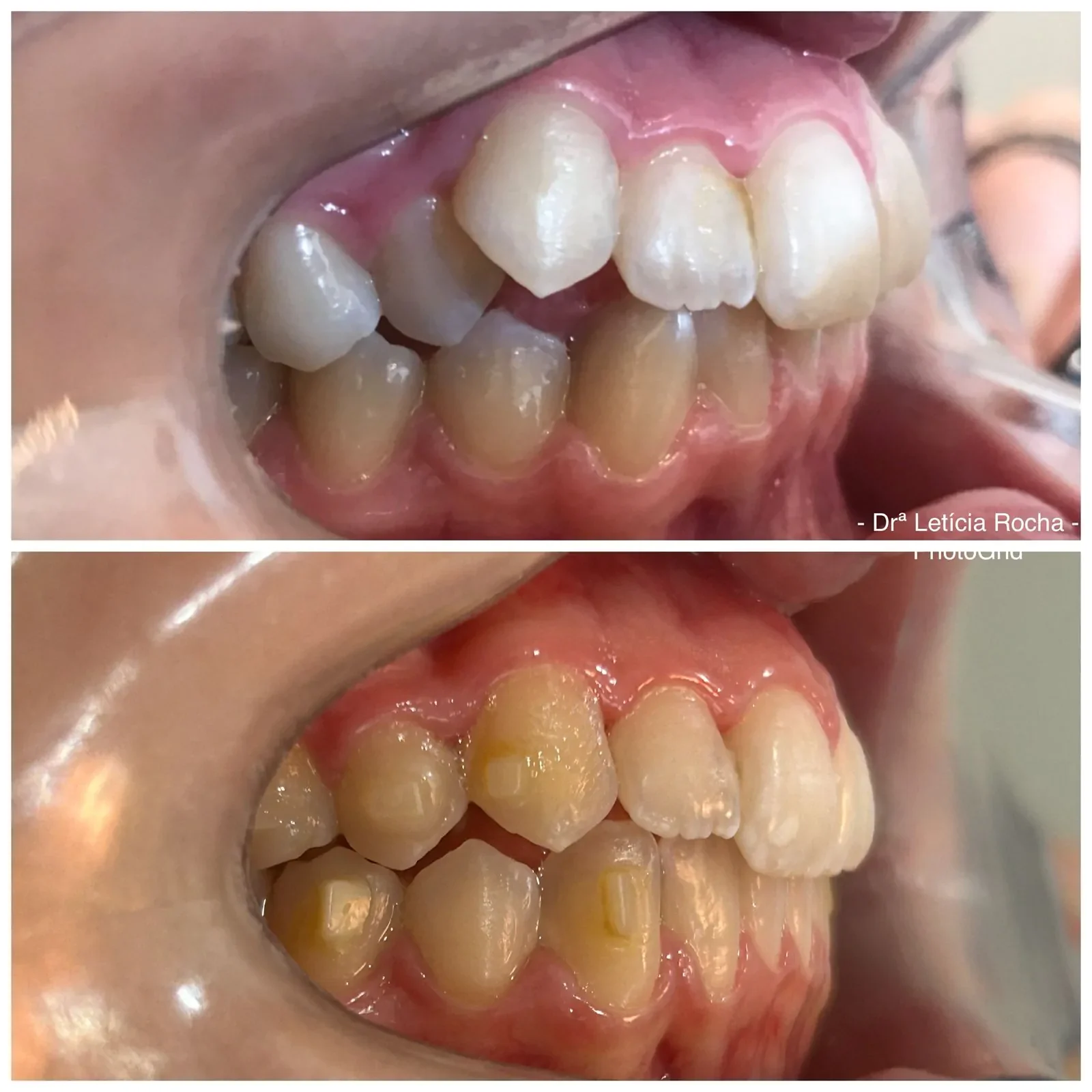 Antes e depois alinhadores &mdash; Violeta