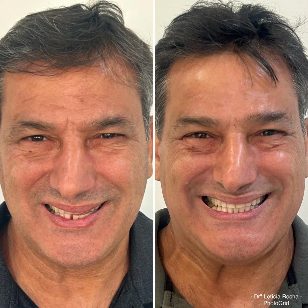 Adilson &mdash; antes e depois com aparelho invis&iacute;vel