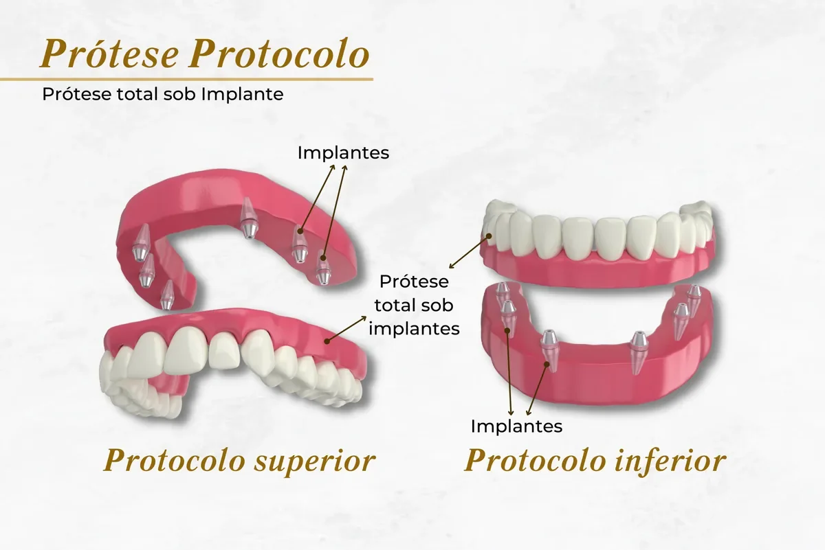 Prótese sobre implante e protocolo em Brasília: tipos, preço e como funciona