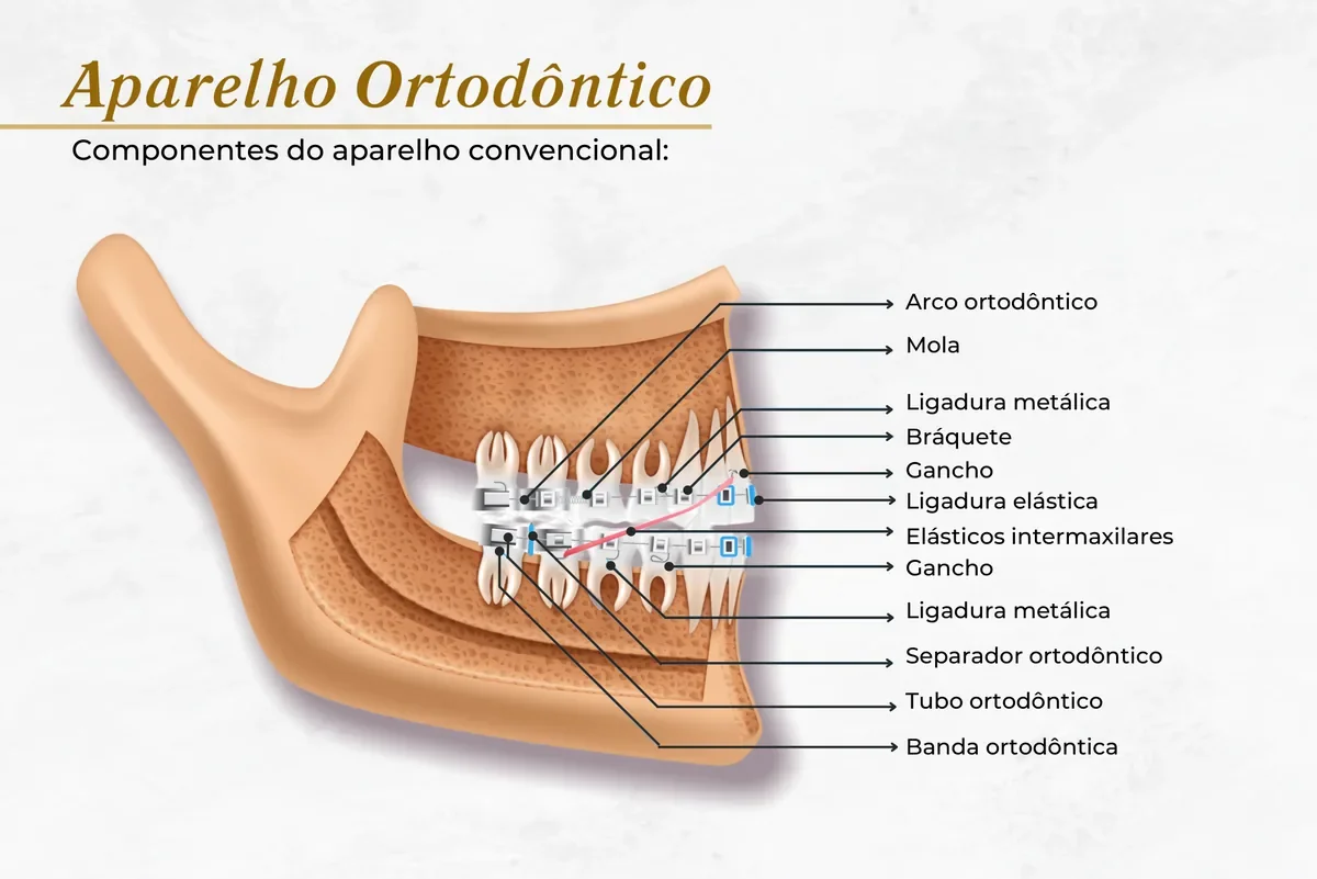 Componentes do aparelho fixo convencional — Abilità, Brasília