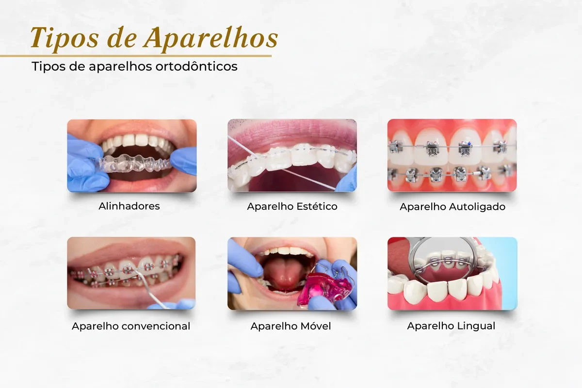 Ortodontia em Brasília: tipos de aparelho, quando fazer e preço