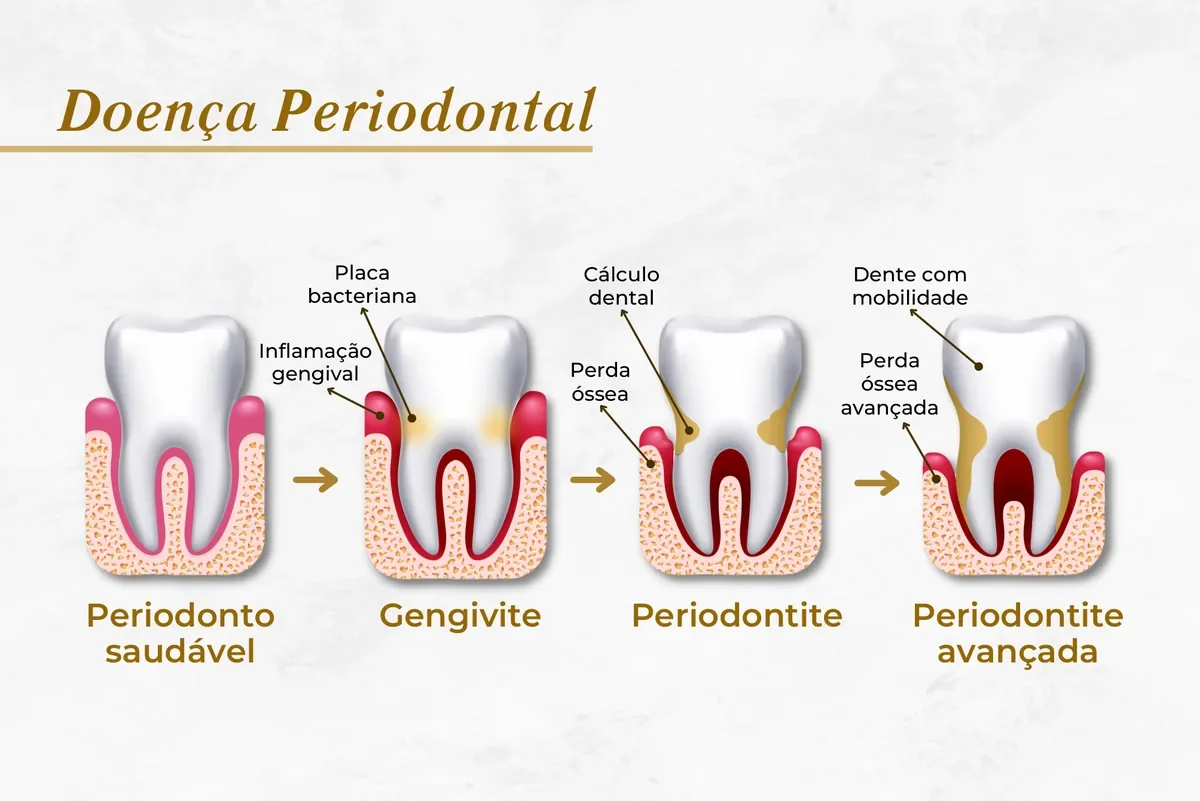 Doença periodontal: o que é, estágios, sintomas e tratamento em Brasília