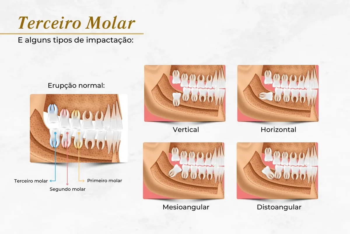 Siso incluso: quando extrair, como é a cirurgia e o que esperar