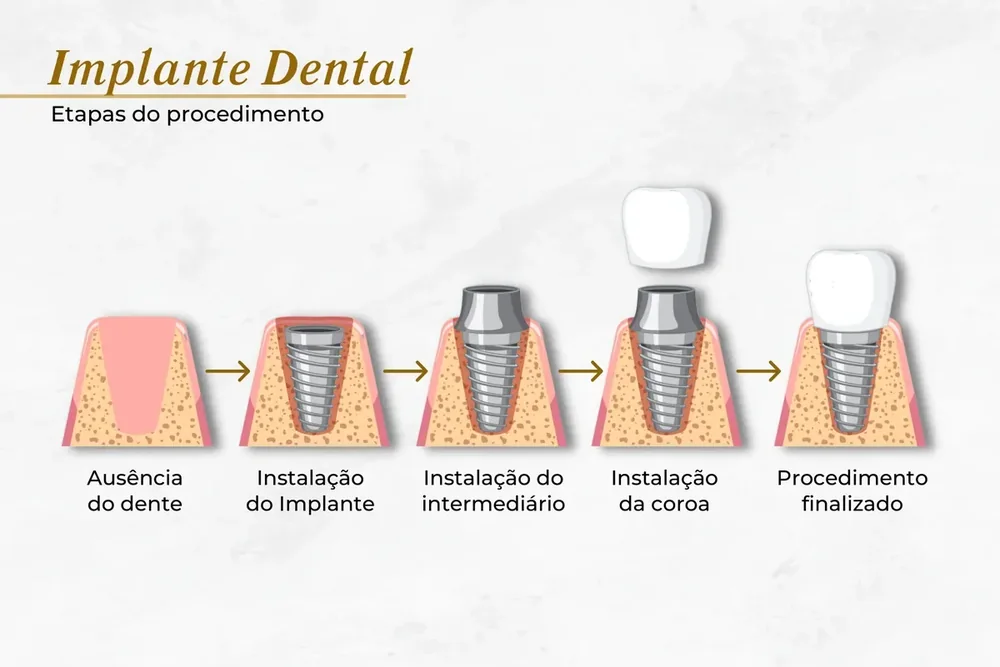 4 etapas do implante dent&aacute;rio