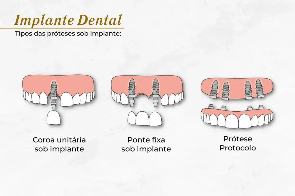 Tipos de implante: unit&aacute;rio, ponte fixa e protocolo
