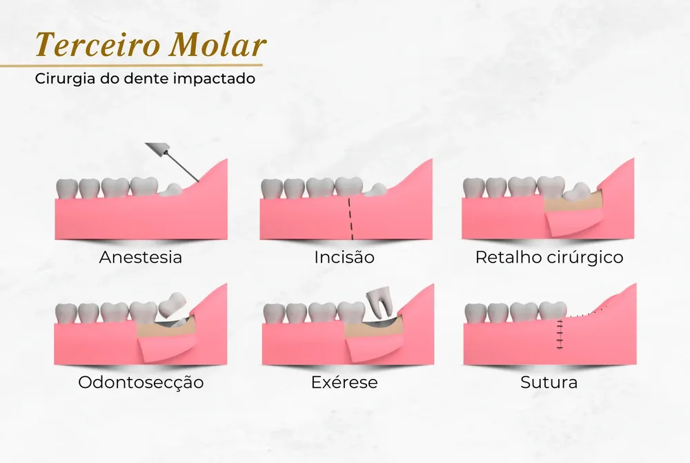Passo a passo da cirurgia de extra&ccedil;&atilde;o de siso